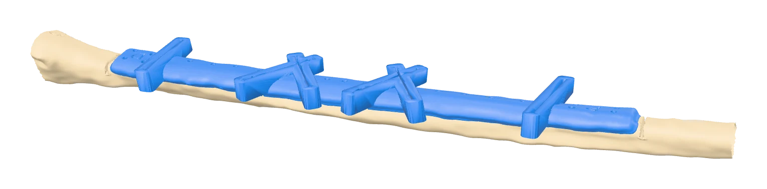 Fibula with cutting guide