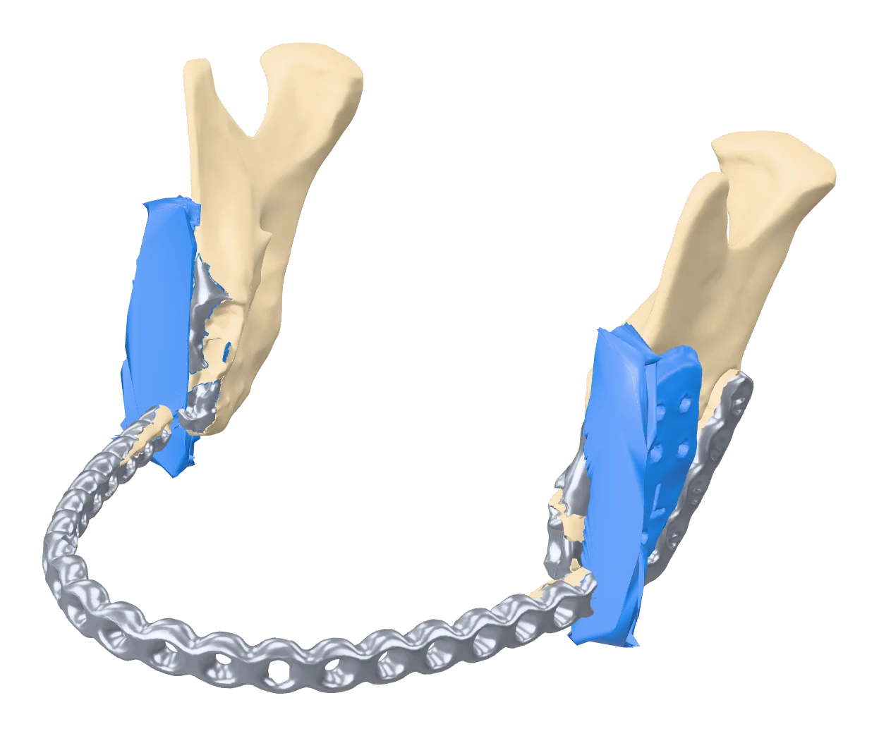 Resection guides on the mandible
