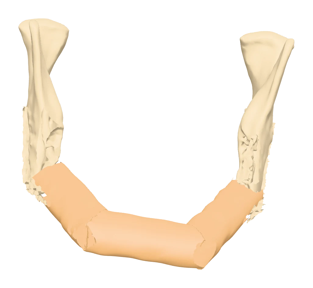 Reconstructed mandible