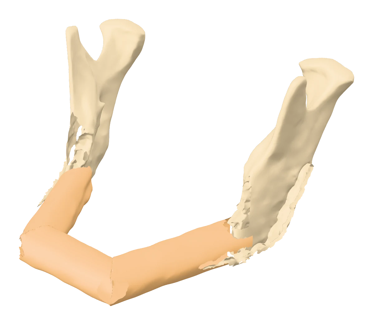 Mandible reconstructed with fibula segments