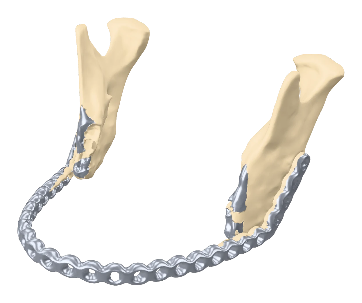 Mandible with existing reconstruction plate