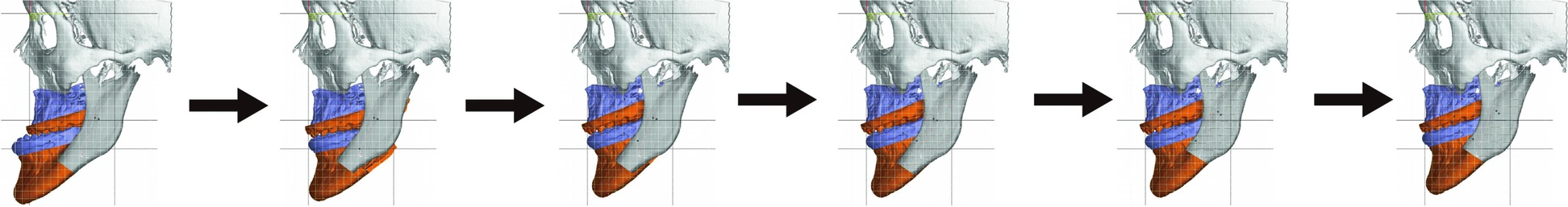 Six-step virtual plan of bimaxillary orthognathic surgery