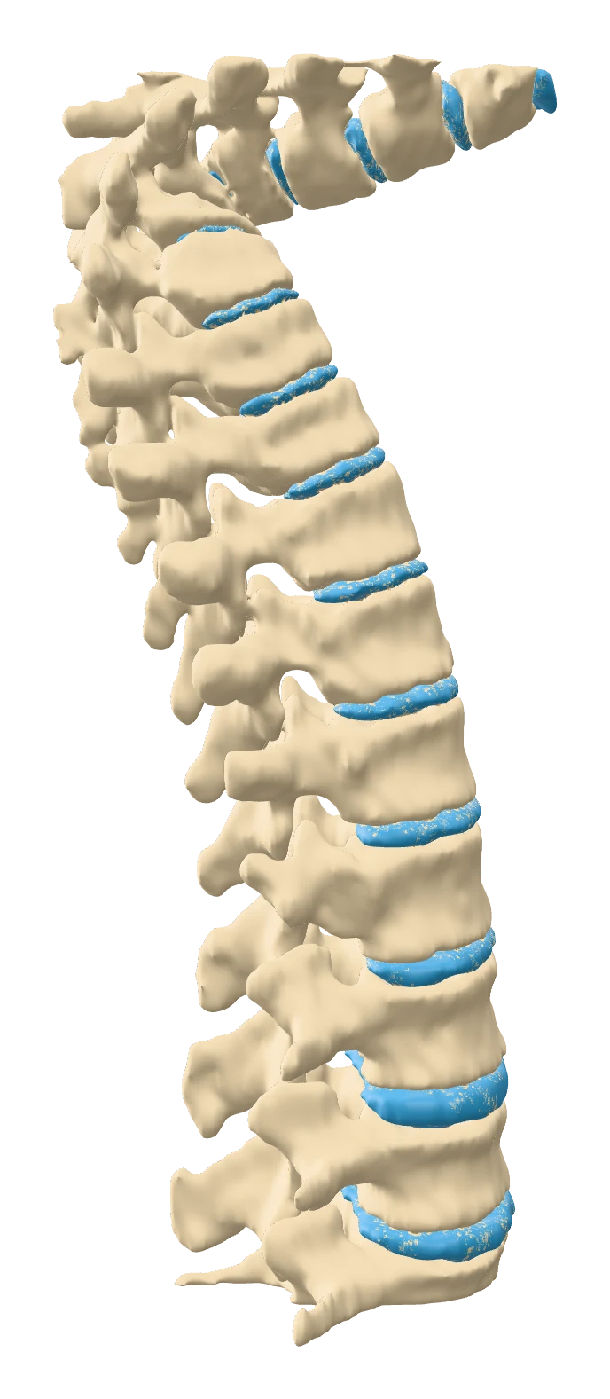 Spine with severe kyphosis